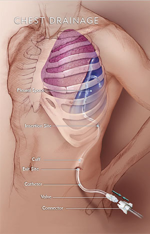 Indwelling Pleural Catheter Placement